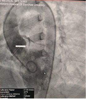 Case Sharing | Encerramento Bem-sucedido de VSD Tipo Aneurisma Septal Membranoso de Multi-Saída Usando Occluder Biodegradável MemoSorb