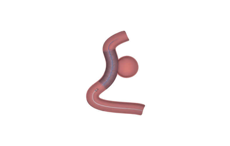 Flow Diversion