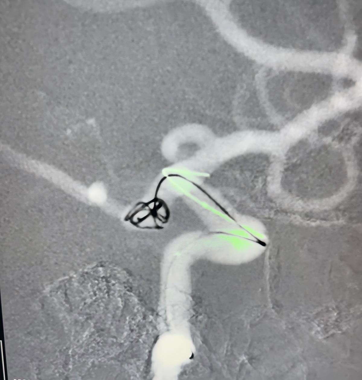 Kliniczny reflektor | Nuva Flow Diverter w leczeniu tylnego, komunikującego się tętniaka tętnicy