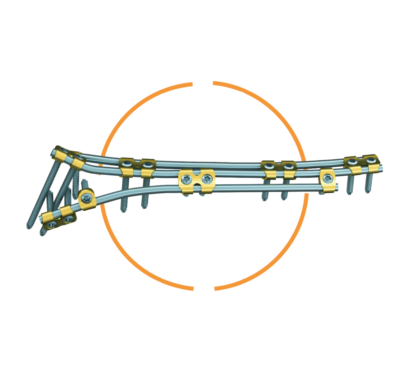 Sistema de puente ortopédico (OBS)-Producto patentado