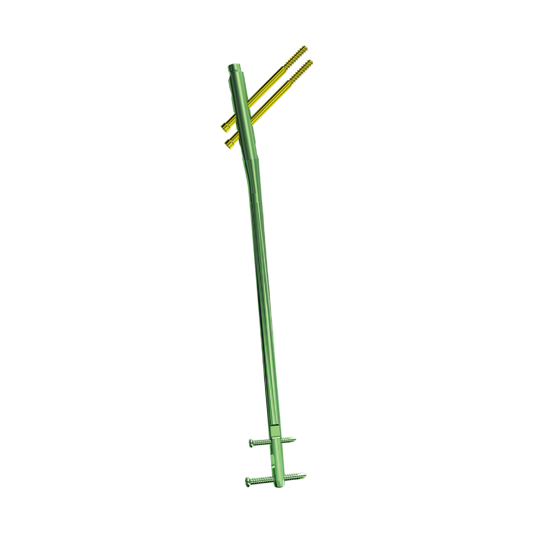 Reconstrucción femoral Sistema de clavos entrelazados (II)