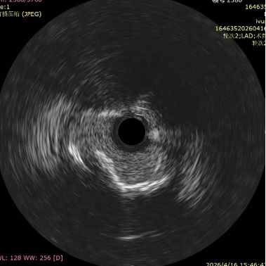 First-in-China RattleSight IVUS Use: Breakthrough for Precise PCI from Beijing AerospaceGeneral Hospital